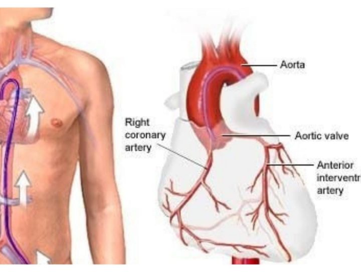 Coronary Angiography